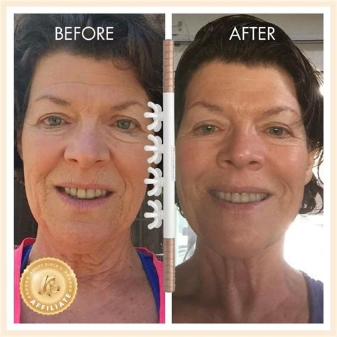 fascia blasting before and after face